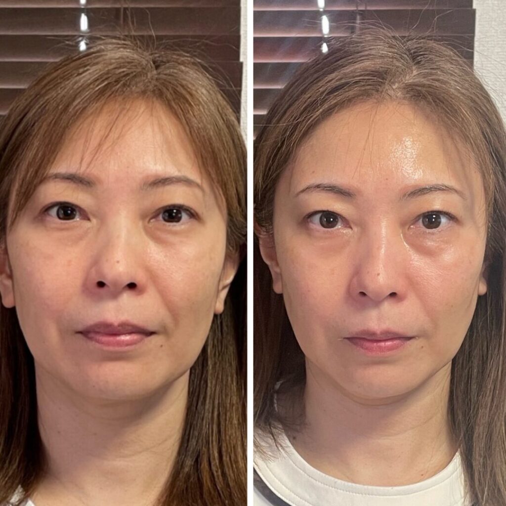 施術before/after
