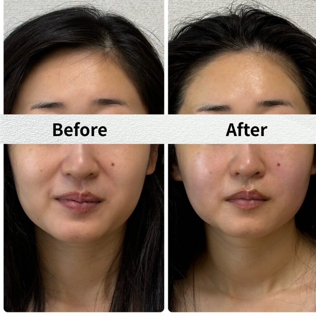施術before/after